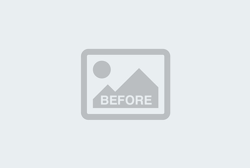Before Image: Hair Restoration Treatment - front