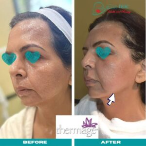 before after thermage flx treatment Sugar Land TX