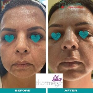 before after thermage flx Sugar Land TX