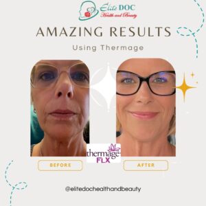 before after thermage flx skin treatment Sugar Land TX