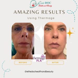 before after thermage flx laser skin treatment Sugar Land TX