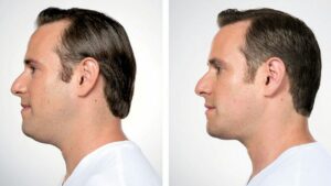before after kybella chin scultping treatment men