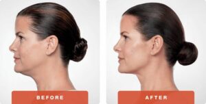 before after kybella chin treatement