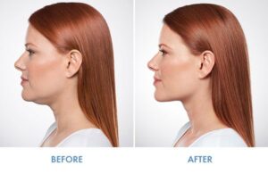 before and after Kybella Sugar Land TX
