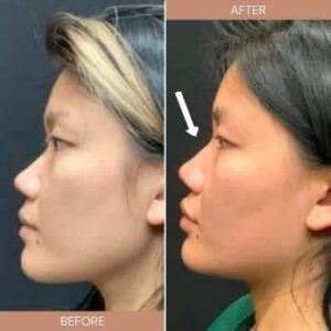 before and after Radiesse treatment Sugar Land TX