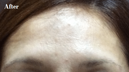 After Image: Botox-Forehead - front