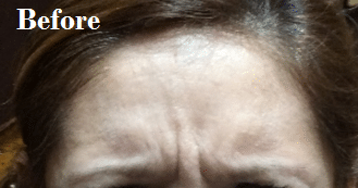 Before Image: Botox-Forehead - front