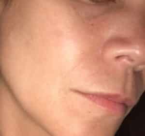 After Image: IPL Photofacial