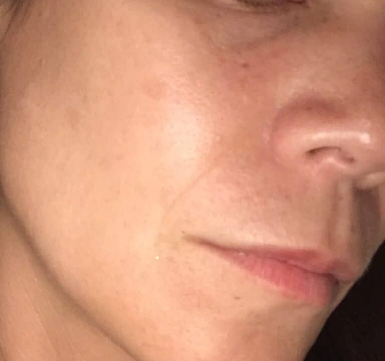 After Image: IPL Photofacial - front