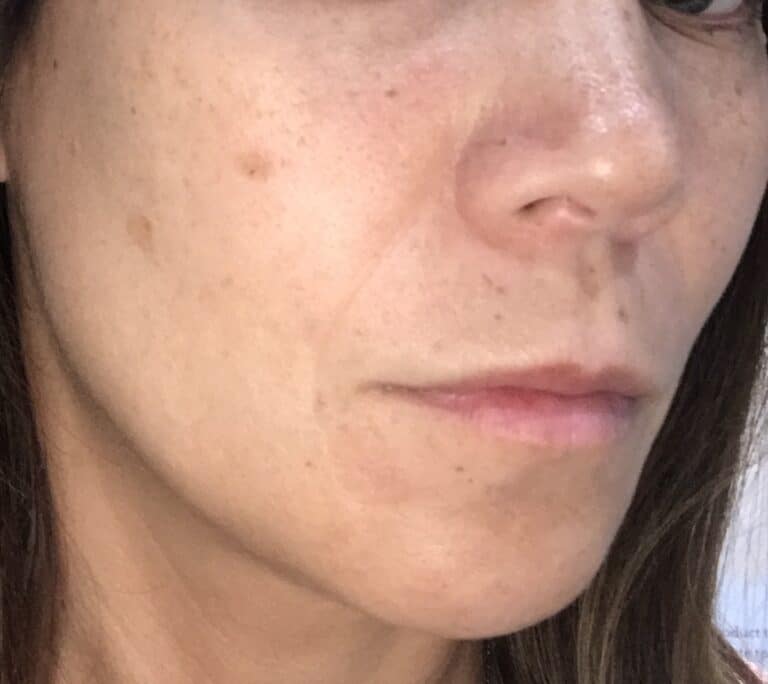 Before Image: IPL Photofacial - front