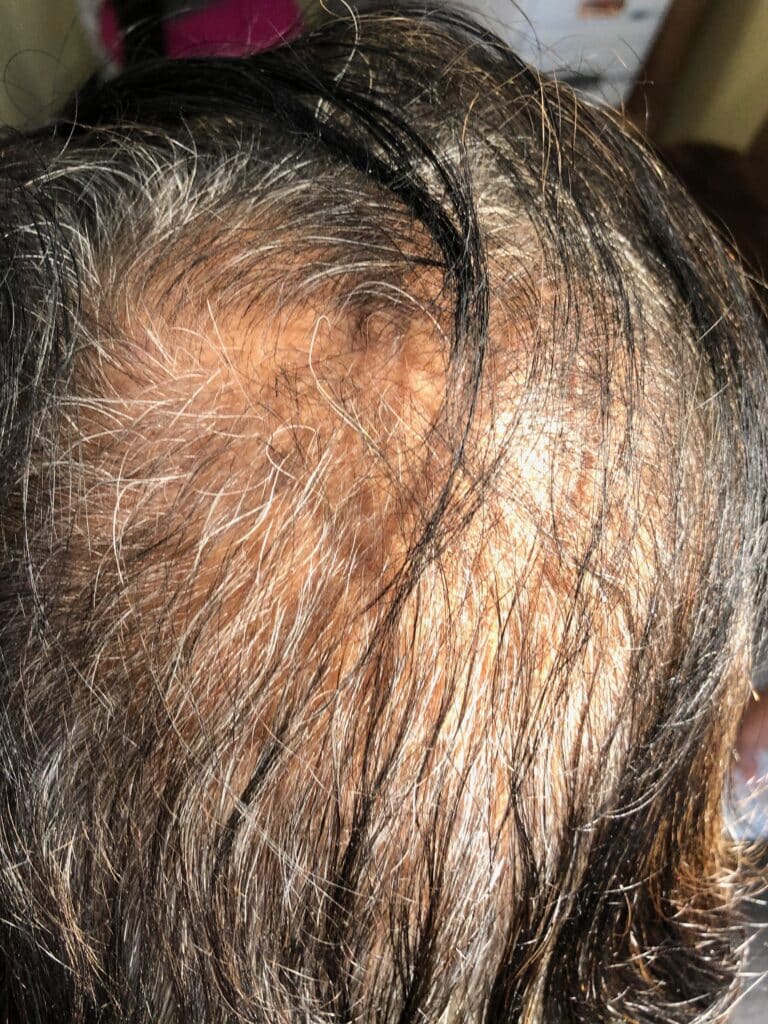 After Image: Microneedling RF with PRP for hair growth - front
