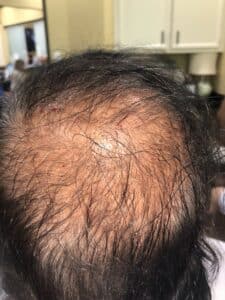 Before Image: Microneedling RF with PRP for hair growth