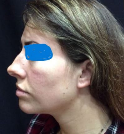 Before Image: Non-surgical rhinoplasty - front