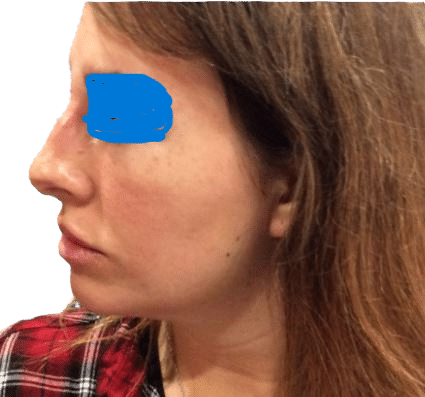 After Image: Non-surgical rhinoplasty - front