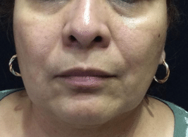 Before Image: Bellafill after 5 years - front