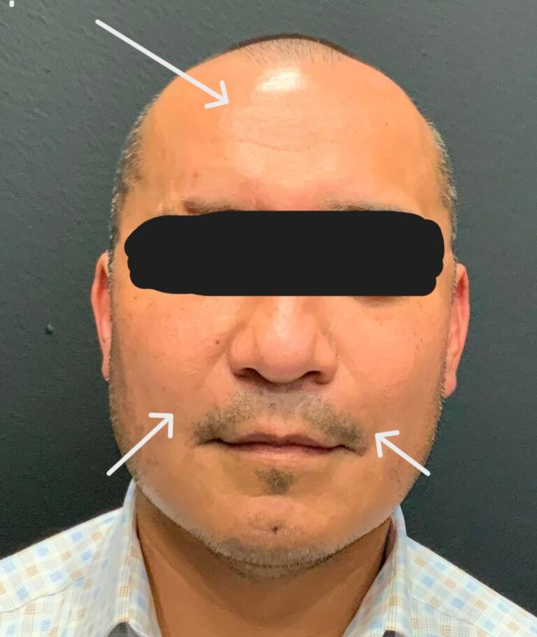 After Image: Bellafill to reduce smile lines Botox reduce wrinkles - front