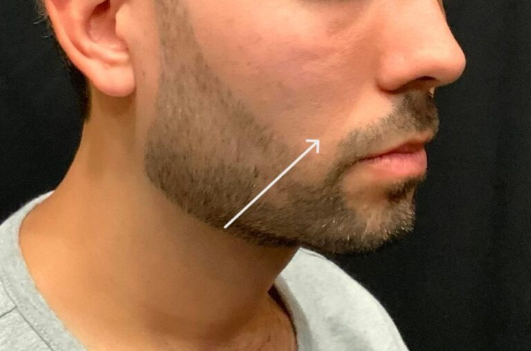 Before Image: Bellafill for smile lines - right-side
