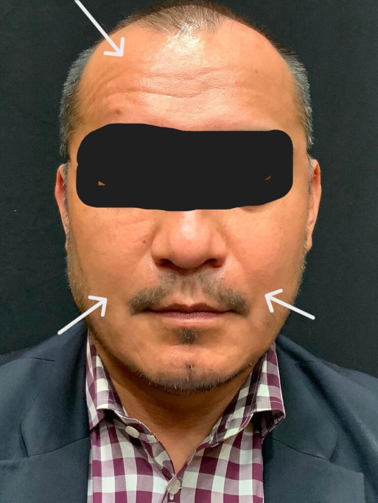 Before Image: Bellafill to reduce smile lines Botox reduce wrinkles - front