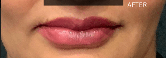 After Image: Juvederm Ultra Plus Lips Enhancement - front