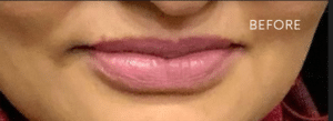 Before Image: Juvederm Ultra Plus Lips Enhancement