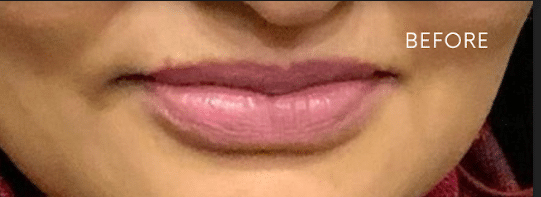 Before Image: Juvederm Ultra Plus Lips Enhancement - front