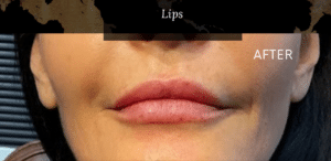 After Image: Add Volume to lips Juvederm Ultra Plus