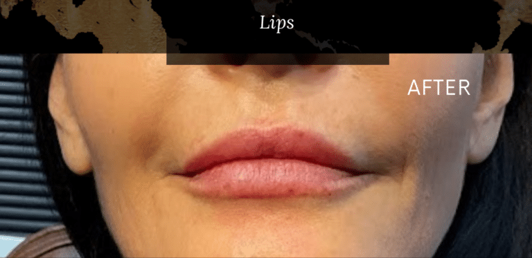 After Image: Add Volume to lips Juvederm Ultra Plus - front