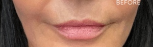 Before Image: Add Volume to lips Juvederm Ultra Plus