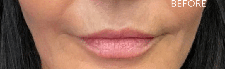 Before Image: Add Volume to lips Juvederm Ultra Plus - front
