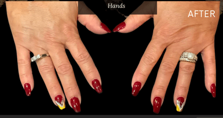 After Image: Hands Treatment with Bellafill - front