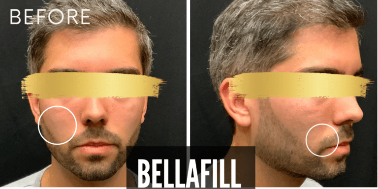 Before Image: Male Treated with Bellafill -