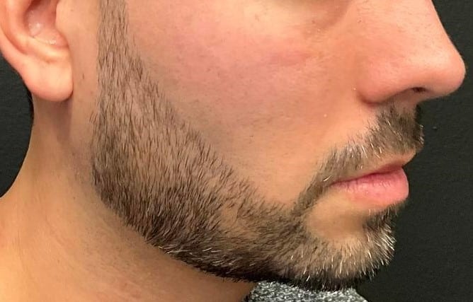 After Image: Male Treated with Bellafill - right-side