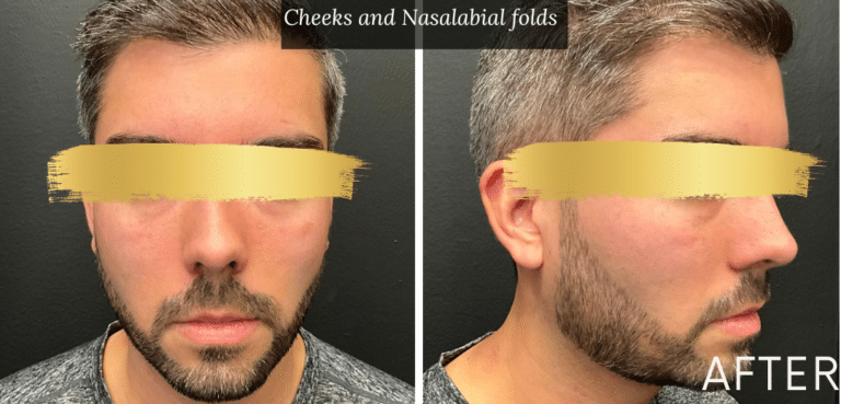 After Image: Male Treated with Bellafill -