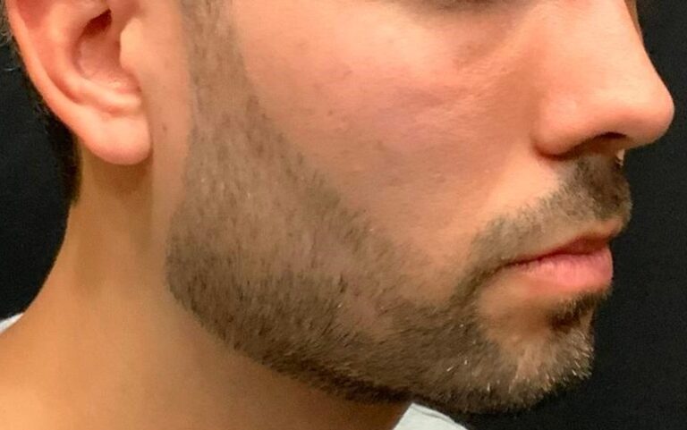 Before Image: Male Treated with Bellafill - right-side
