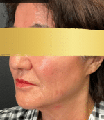 After Image: RHA and Botox Treatments - left-side