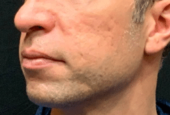 After Image: Bellafill Acne Scar Treatment - front