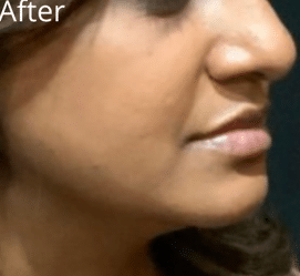 After Image: Bellafill Acne Treatment with Luma Forte Facial Cream - right-side