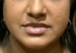 After Image: Bellafill Acne Treatment with Luma Forte Facial Cream - front