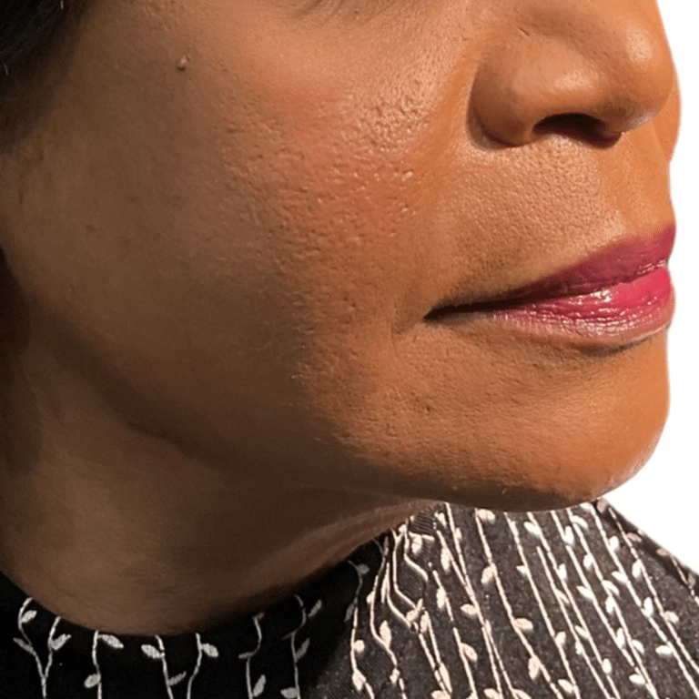 After Image: Bellafill and VittaPure treatment - right-side