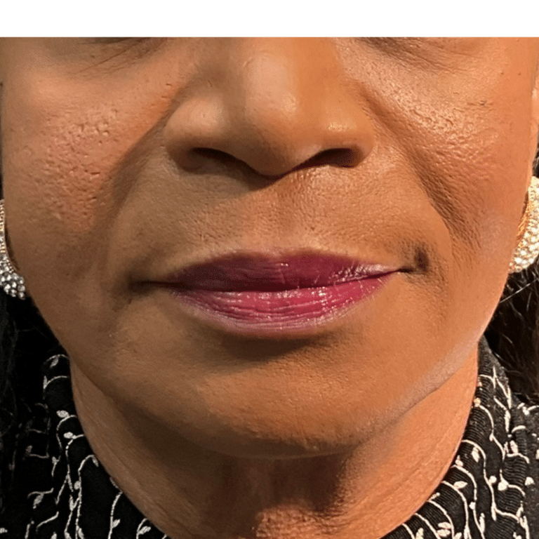 After Image: Bellafill and VittaPure treatment - front