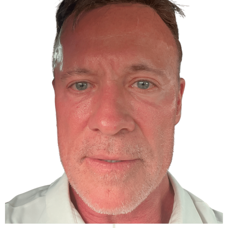 After Image: Bellafill and Thermage FLX face treatment - front