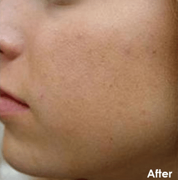 After Image: Chemical Peel Facial - front