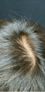 After Image: Microneedling RF with PRP for Hair Loss