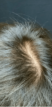 After Image: Microneedling RF with PRP for Hair Loss - front