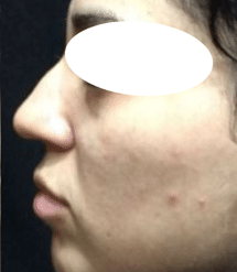 After Image: Non-surgical Rhinoplasty with Radiesse Filler - front