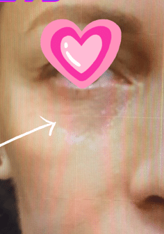 After Image: Plasma IQ Eye treatment - front