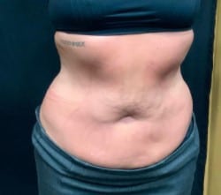 After Image: Emsculpt Body Toning - front