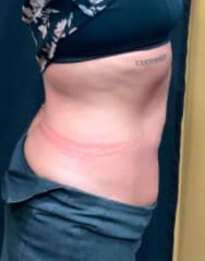 After Image: Emsculpt Body Toning - right-side