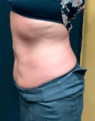 After Image: Emsculpt Body Toning - left-side