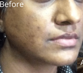 Before Image: Bellafill Acne Treatment with Luma Forte Facial Cream - right-side